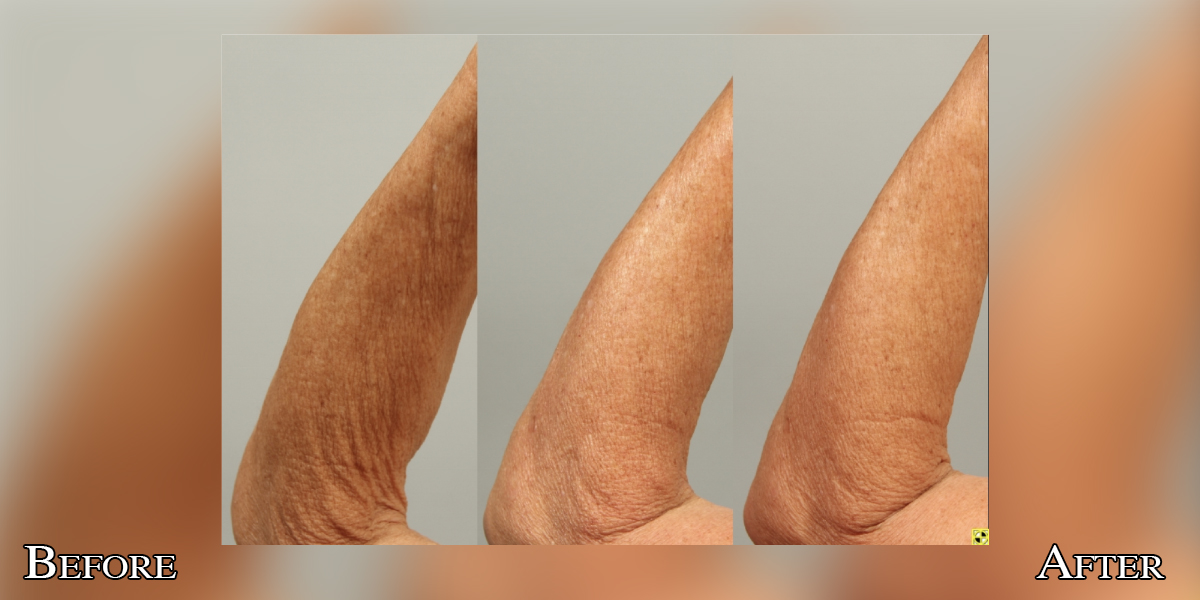 CryoLean before and after — arms