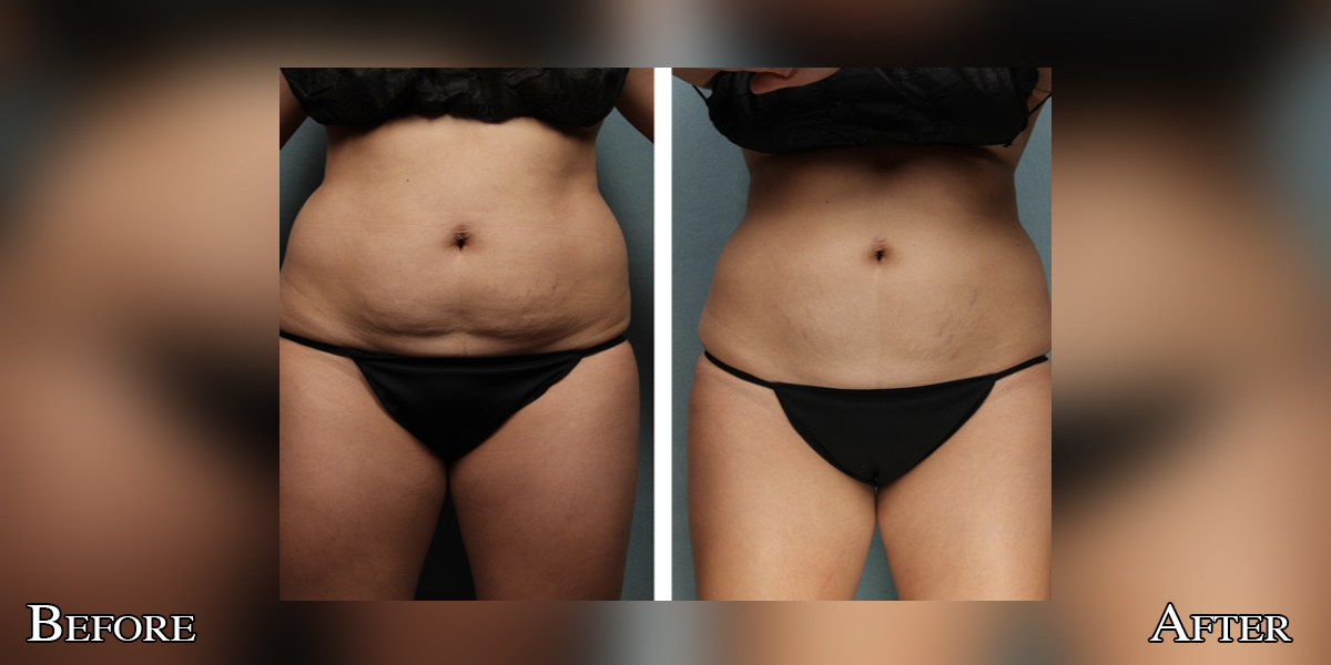 CryoLean before and after — abdomen