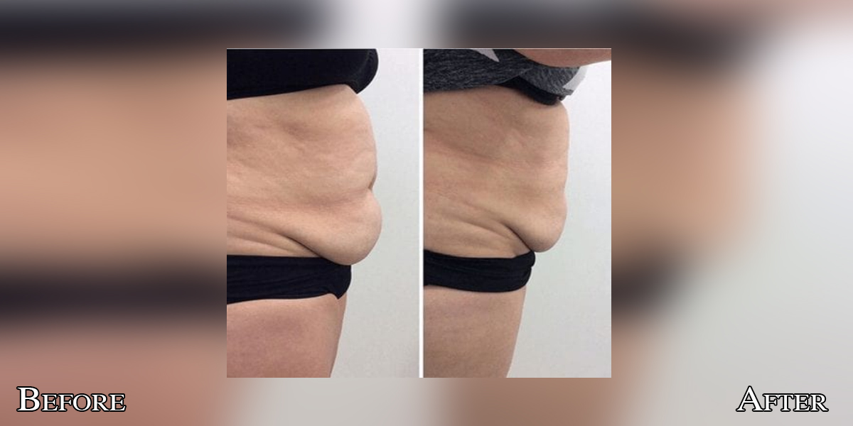 CryoLean before and after — lower belly
