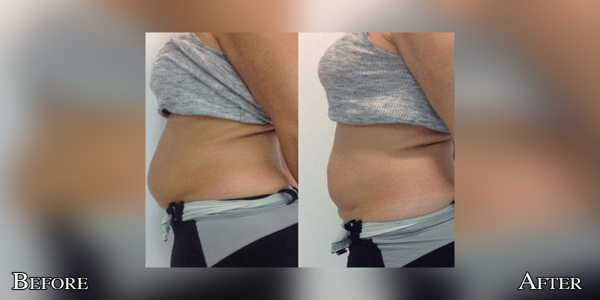 CryoLean before and after — back and flanks