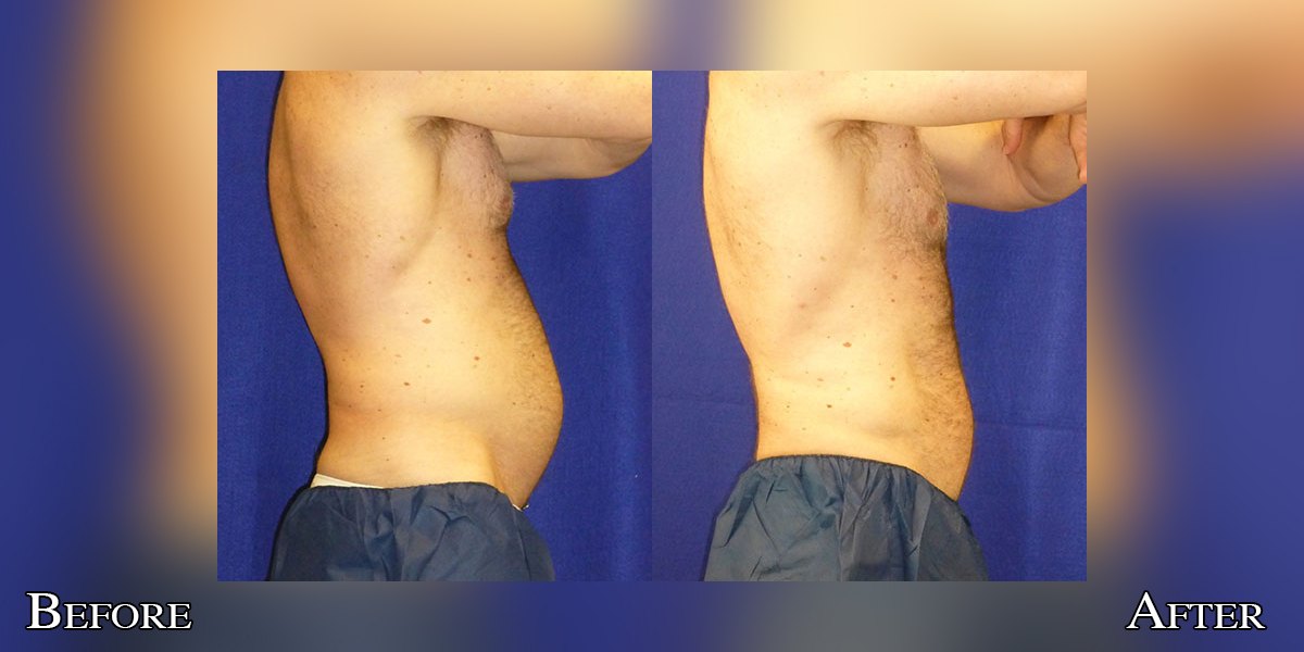CryoLean before and after — abdomen, men