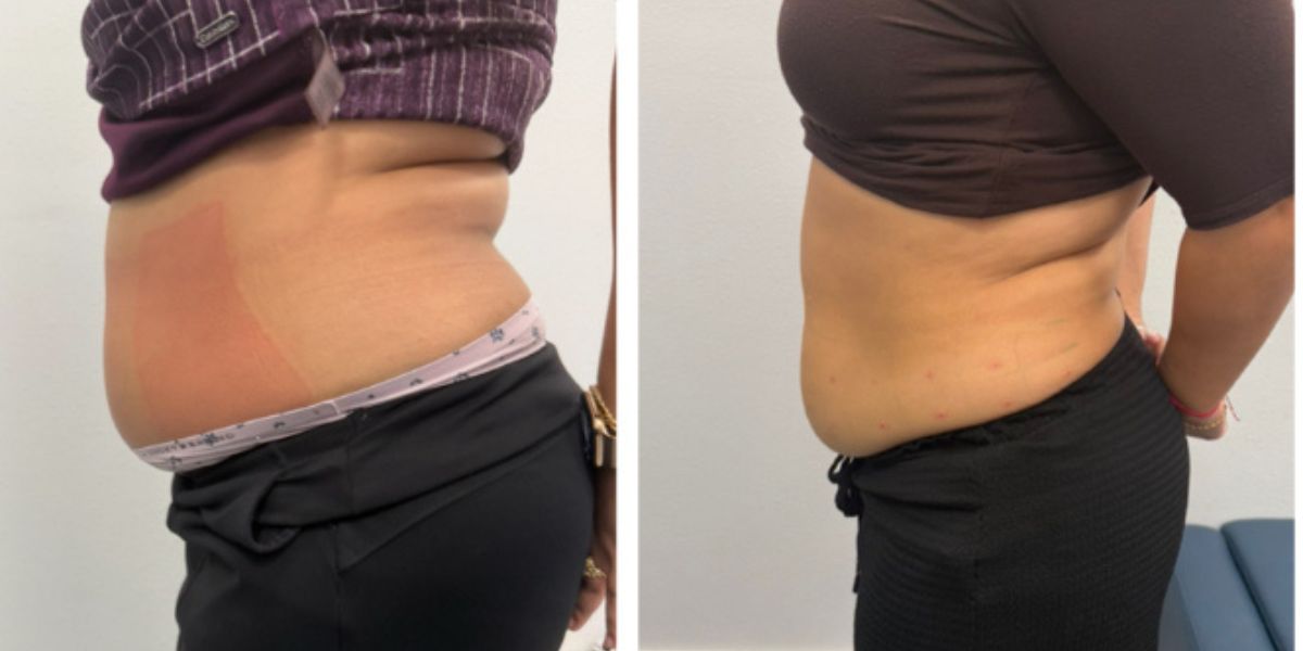 CryoLean before and after — waistline