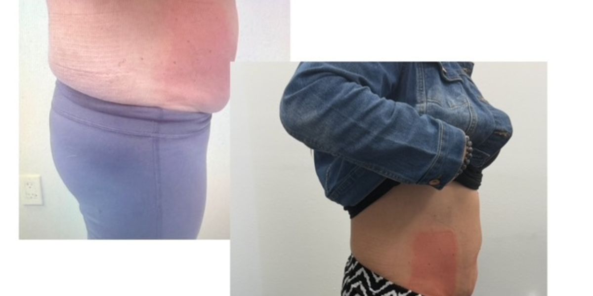 CryoLean before and after — thighs
